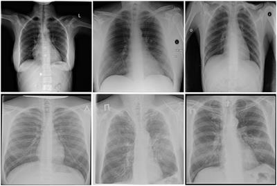 TB-Net: A Tailored, Self-Attention Deep Convolutional Neural Network Design for Detection of Tuberculosis Cases From Chest X-Ray Images